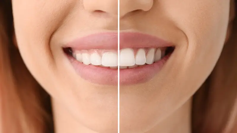 Cosmetic Dentist in Midlothian VA | Transform Your Smile