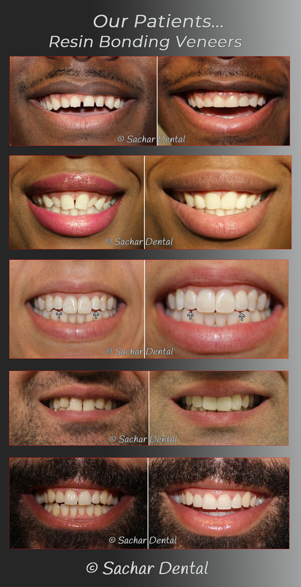 Cosmetic Bonding Cost: How Much Should You Pay for a Perfect Smile?