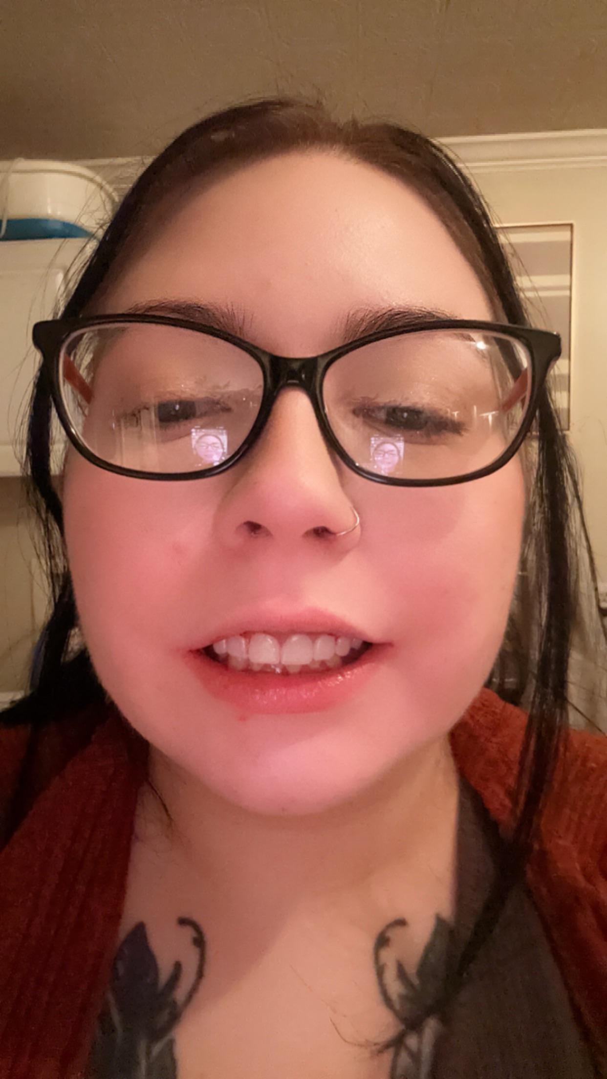 Dentures Ruined My Life: A Real Story of Pain and Regret