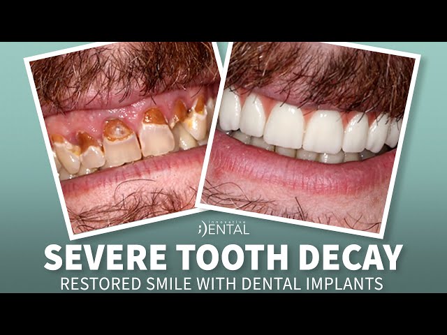 Restore Your Smile with A & A Dental Implant and Cosmetic Center