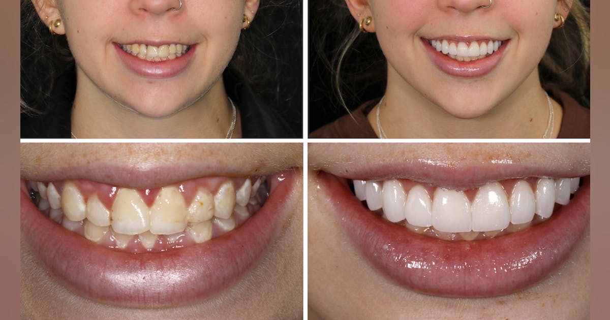 Smile Makeover? a & b dental Specializes in Cosmetic and Implant Dentistry