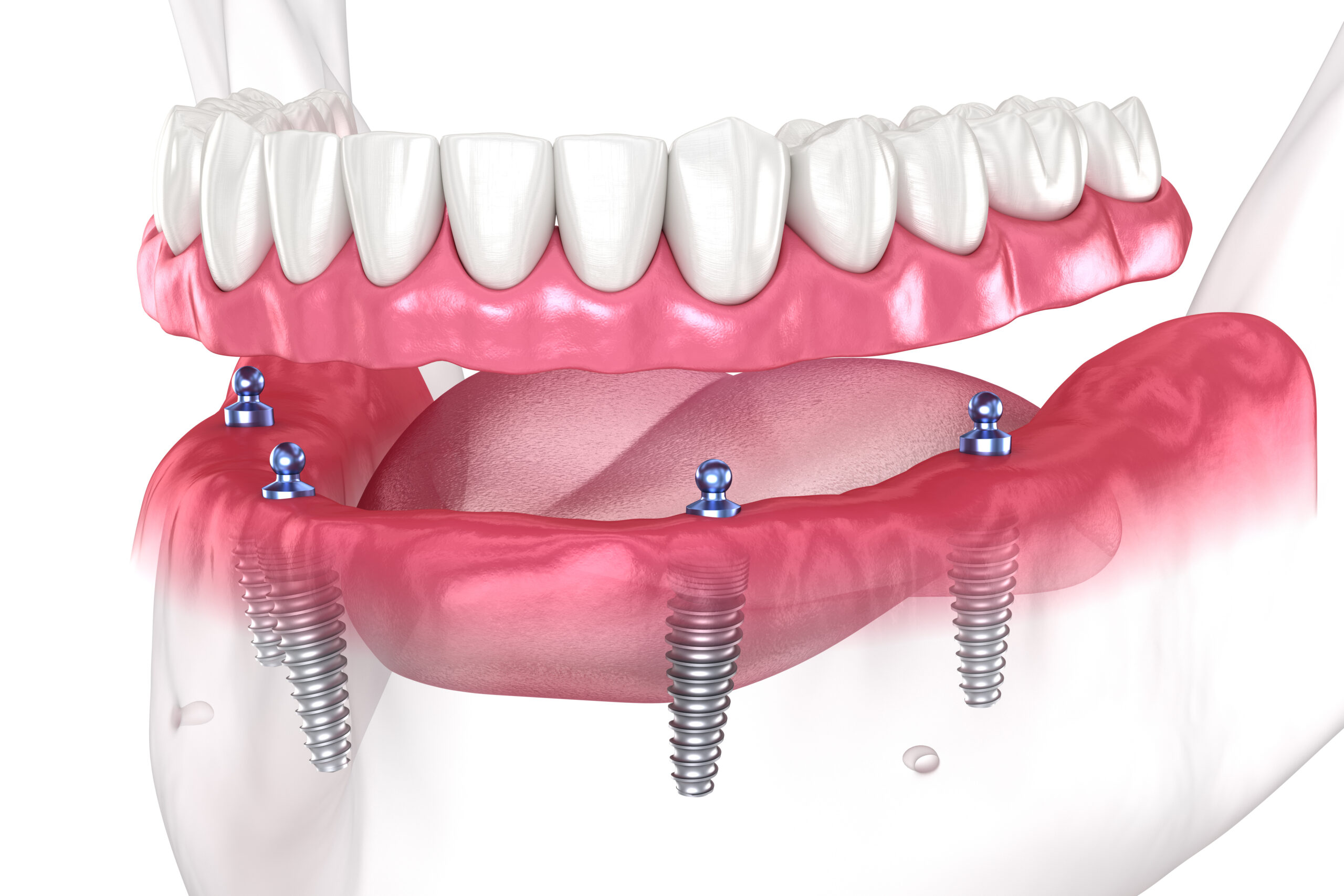 Restore Your Smile with A & A Dental Implant and Cosmetic Center
