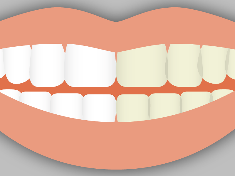Does Delta Dental Cover Cosmetic Dentistry? See What Procedures Are Covered!